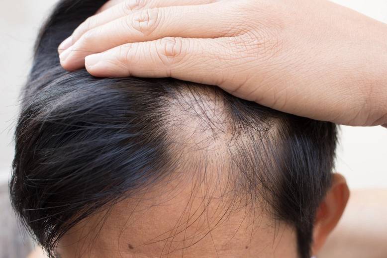 Other Factors That Can Cause Hair Loss: